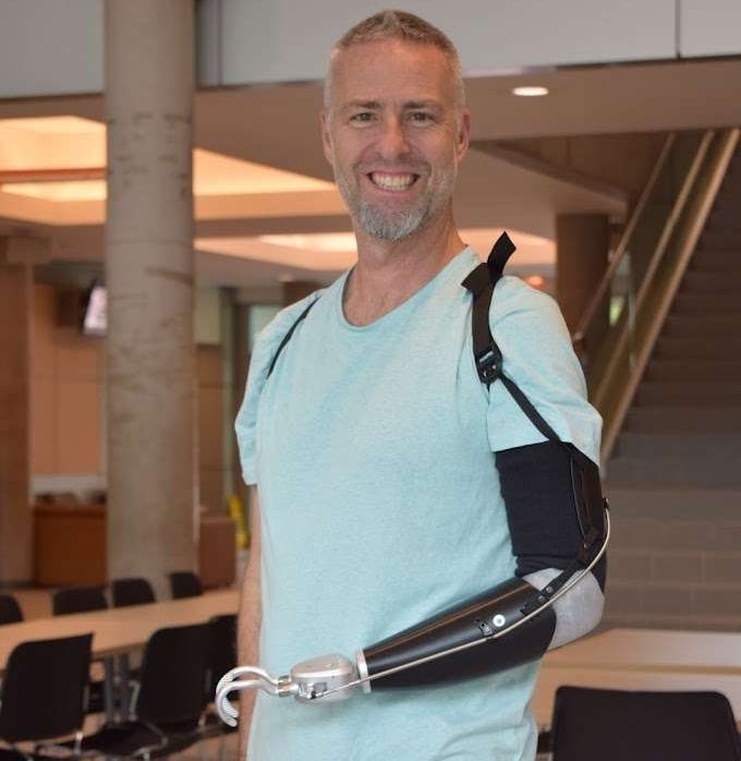 Photo of a man wearing the ProHensor upper limb presthetic